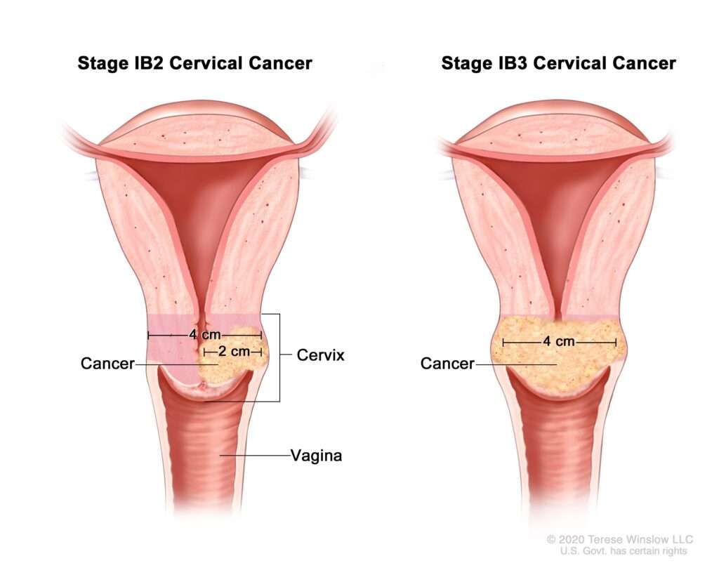 cervical-cancer-scaled
