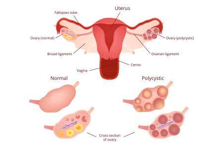 what-is-pcod-or-pcos